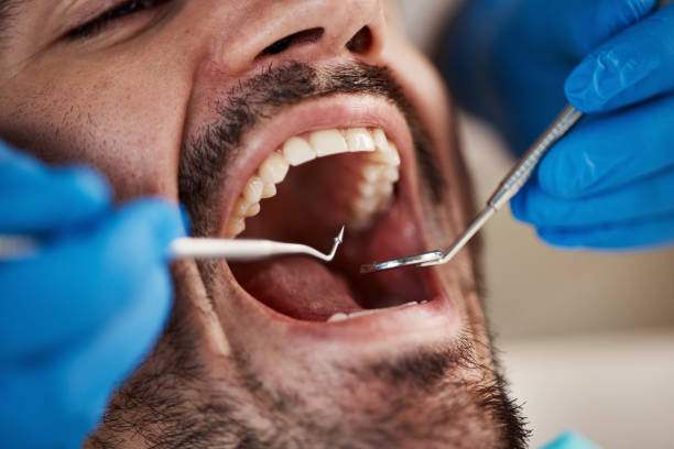 Best Knocked-Out Tooth (Avulsed Tooth) Treatment in White River Junction, VT